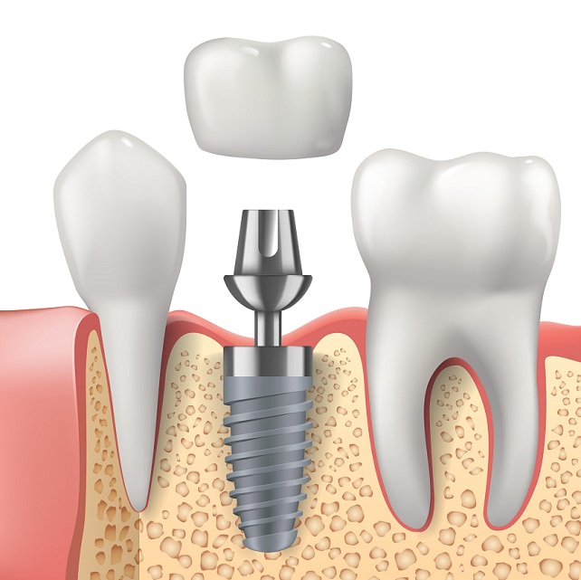Dental Implants Woodbury, Cottage Grove & Stillwater MN Dental Implant Procedure Hudson WI