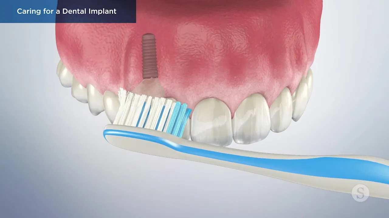 Caring for a Dental Implant Video Thumbnail